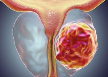 Prostat Büyümesinde Ameliyatsız Yöntem: Rezum (Su Buharı) Tedavisi