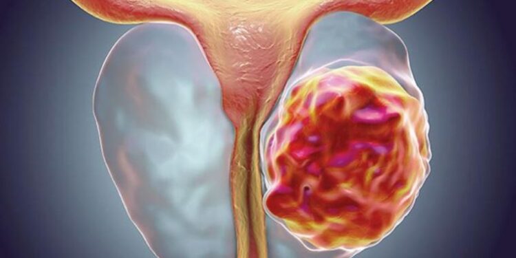 Prostat Büyümesinde Ameliyatsız Yöntem: Rezum (Su Buharı) Tedavisi