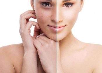 Dr. Taha Klinik Bilgilendiriyor: Fraksiyonel karbondioksit lazer nedir?