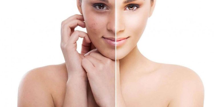 Dr. Taha Klinik Bilgilendiriyor: Fraksiyonel karbondioksit lazer nedir?