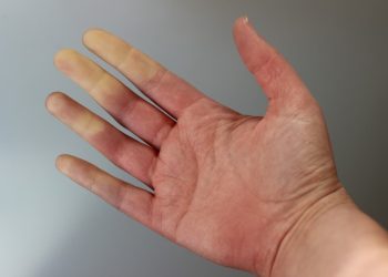 Prof. Dr. Özkan Demirhan: Soğuk havalarda parmaklar morarıyor ya da beyazlıyorsa dikkat!