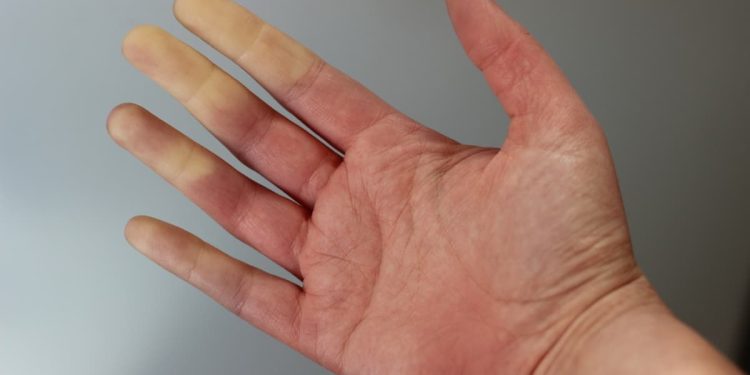 Prof. Dr. Özkan Demirhan: Soğuk havalarda parmaklar morarıyor ya da beyazlıyorsa dikkat!