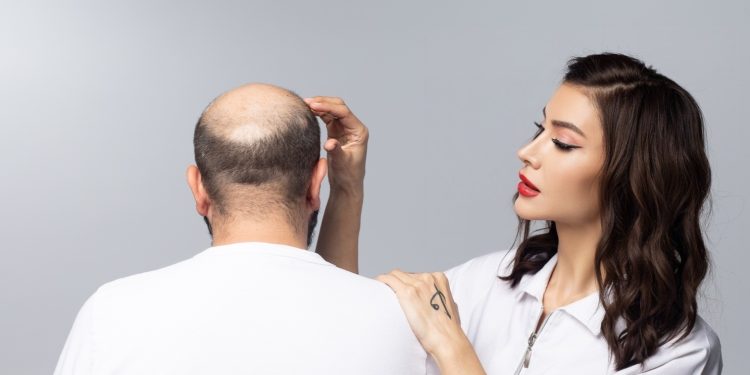 Songül Alcı Yazıyor… Saç Ekimi: Doğru Zaman, Doğru Klinik, Doğal Sonuçlar